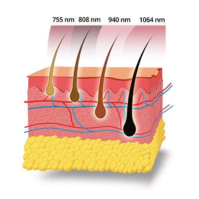 Medilase Pro - Diode ICE Laser met vier golflengten